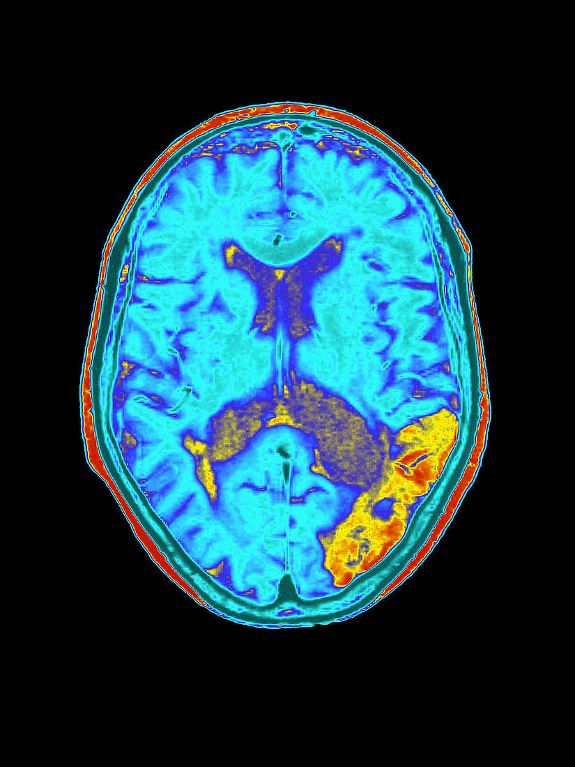 Coloured MRI brain scan showing a stroke