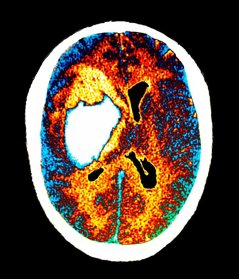 Stroke,brain CT scan