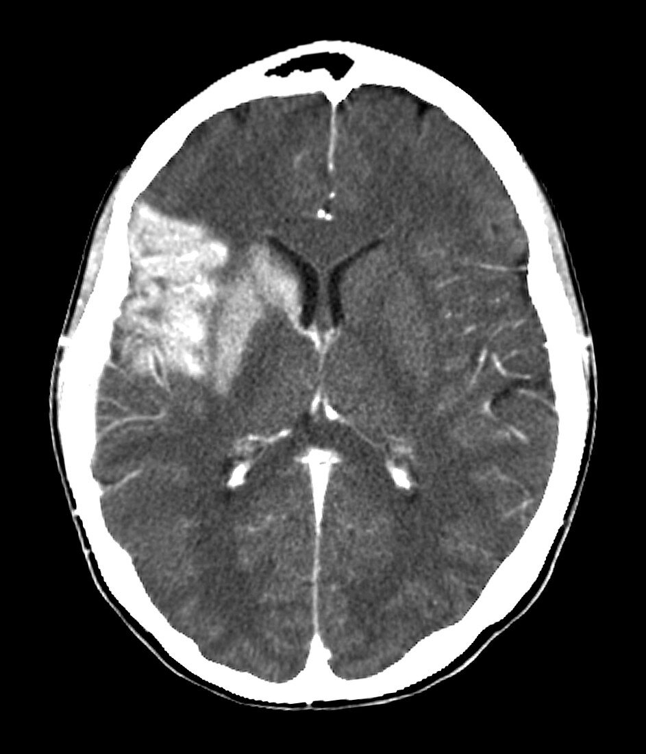 Stroke,CT brain scan