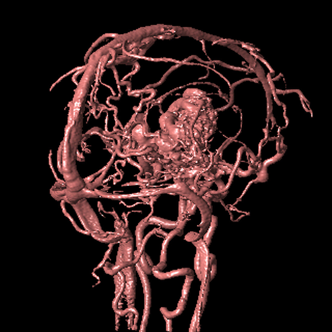 Brain arteriovenous malformation,MRA