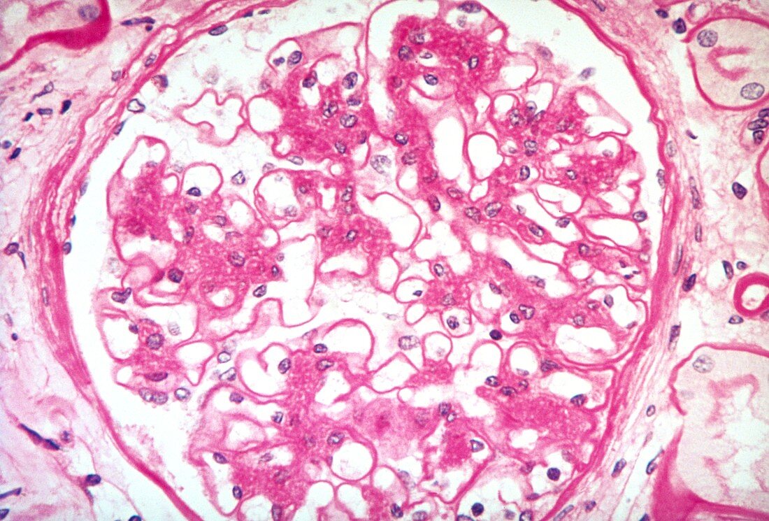 LM of diffuse glomerulus in kidney due to diabetes