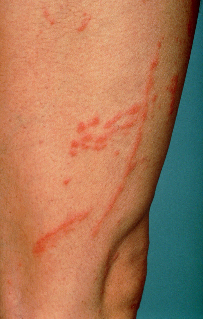Contact dermatitis due to poison oak,showing rash