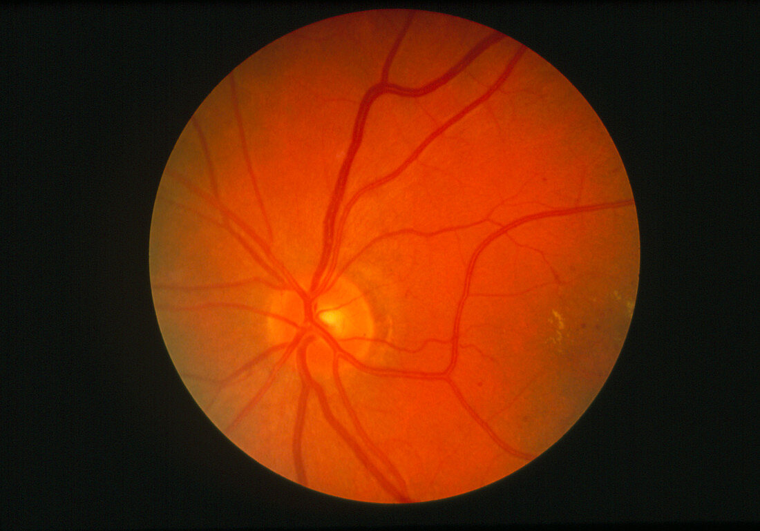 Fundus camera image of mild diabetic retinopathy