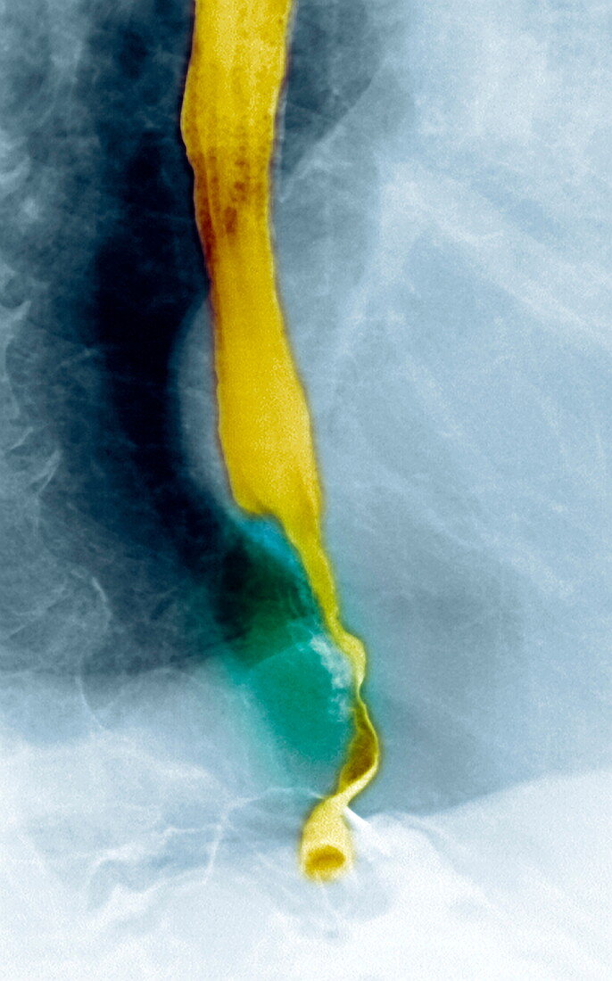 Oesophageal cancer,X-ray