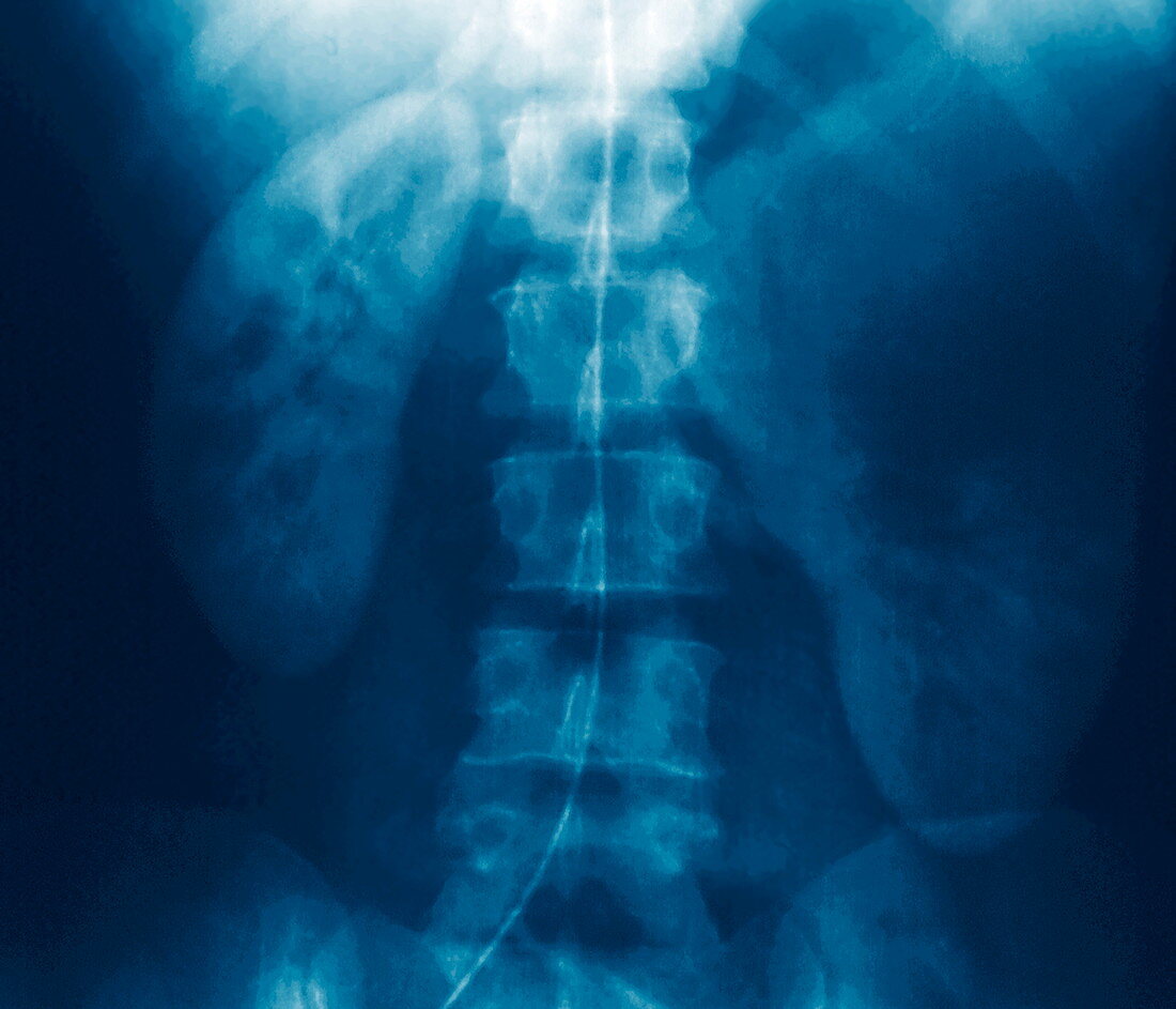 Kidney cancer,X-ray