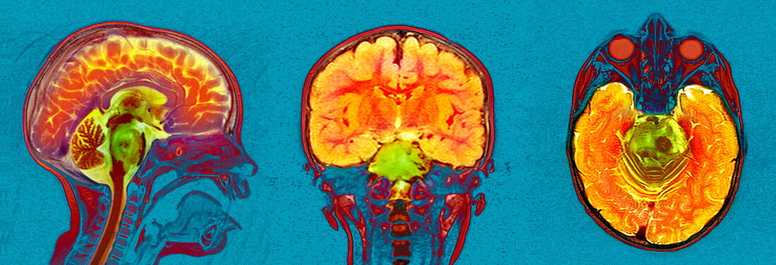 Brain cancer,MRI scan