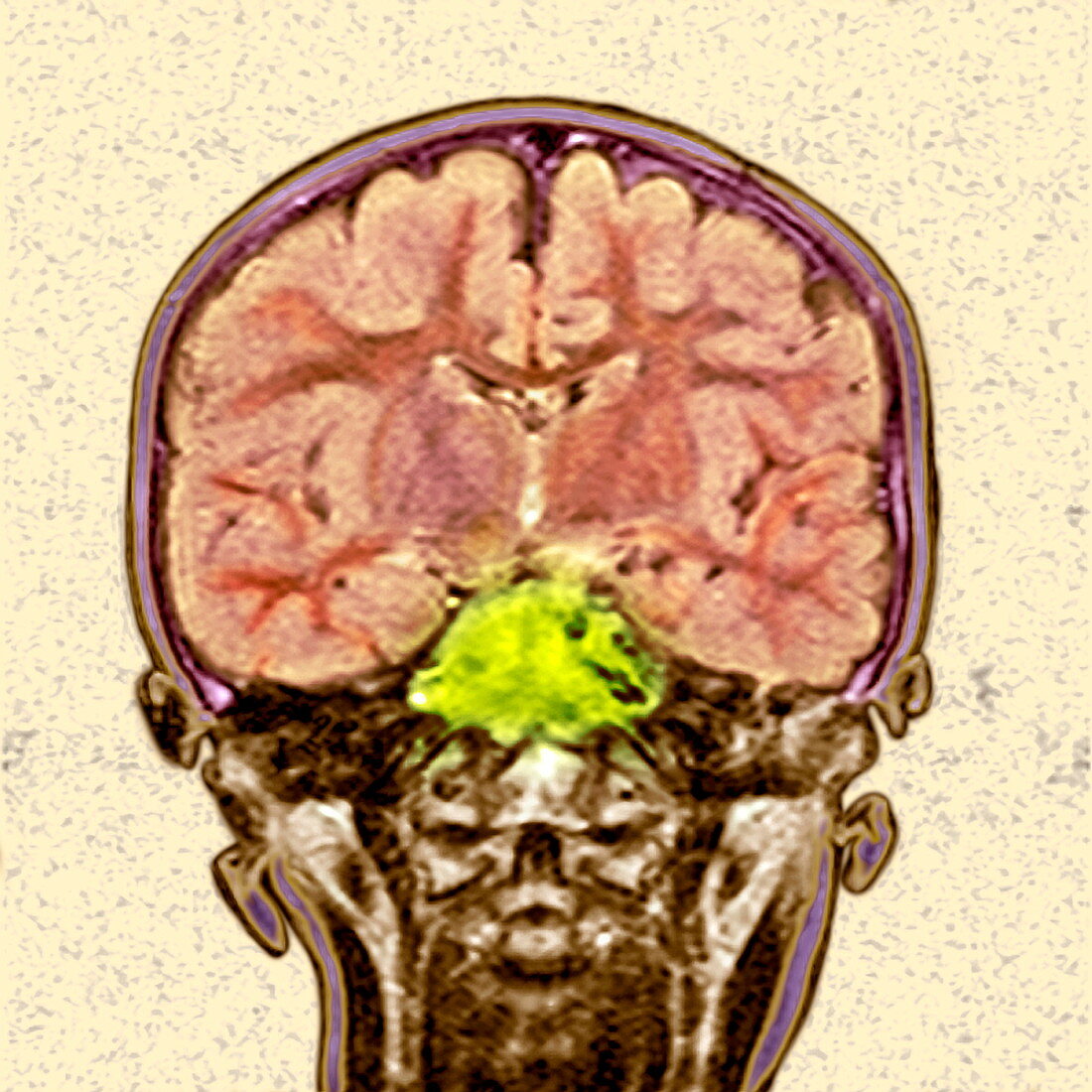 Brain cancer,MRI scan