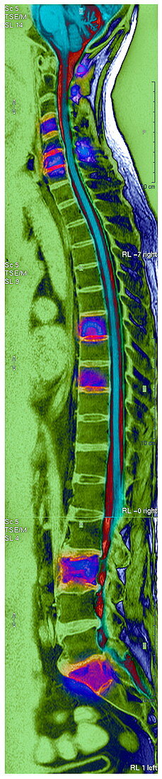 Bone cancer,MRI scan