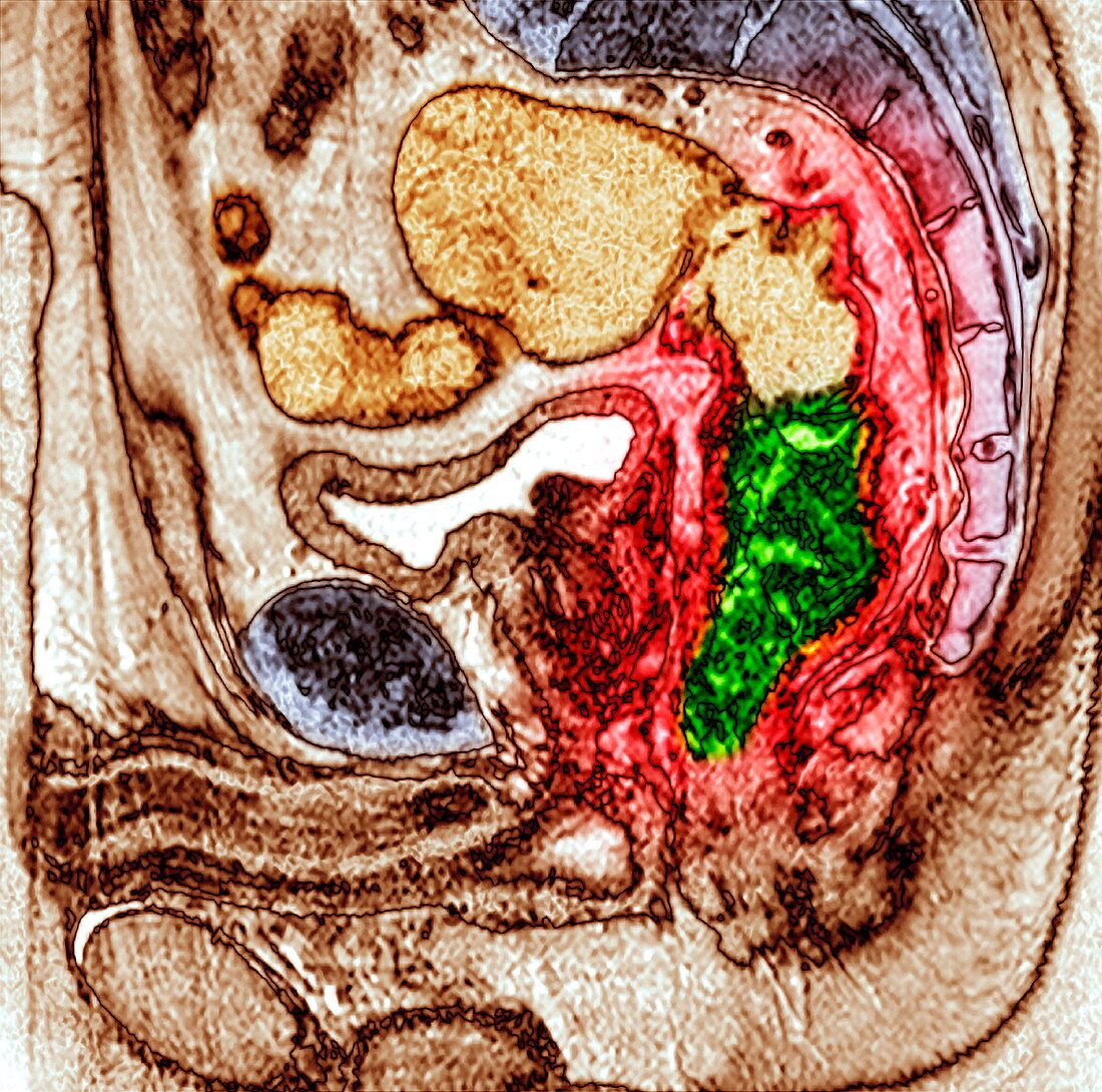 Bowel cancer