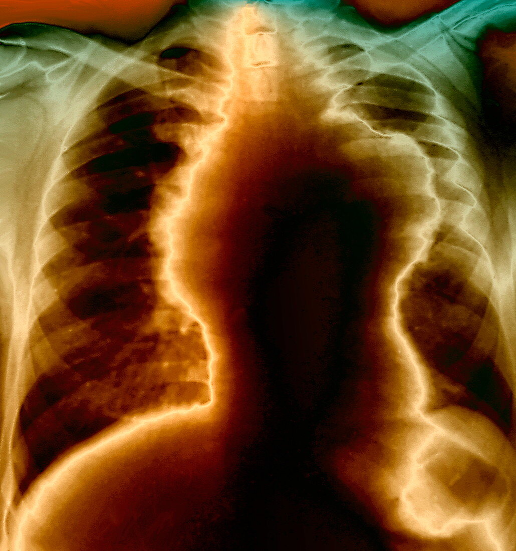 Non-Hodgkin's lymphoma,X-ray