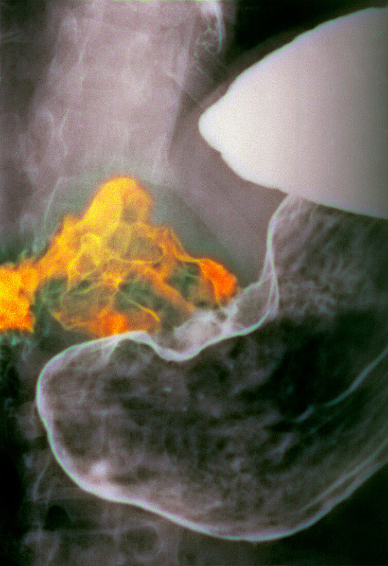 Stomach cancer,X-ray