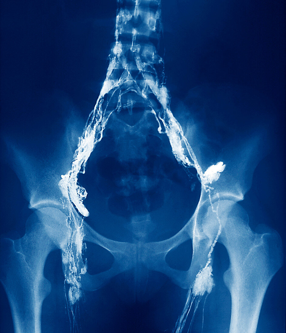 Lymphoma,X-ray