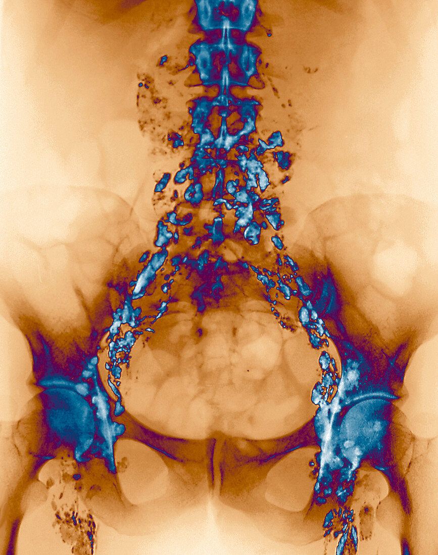 Hodgkin's lymphoma,X-ray
