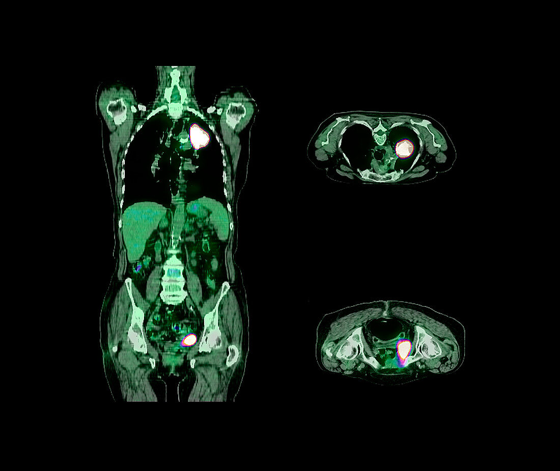 Lung cancer,CT and PET scans