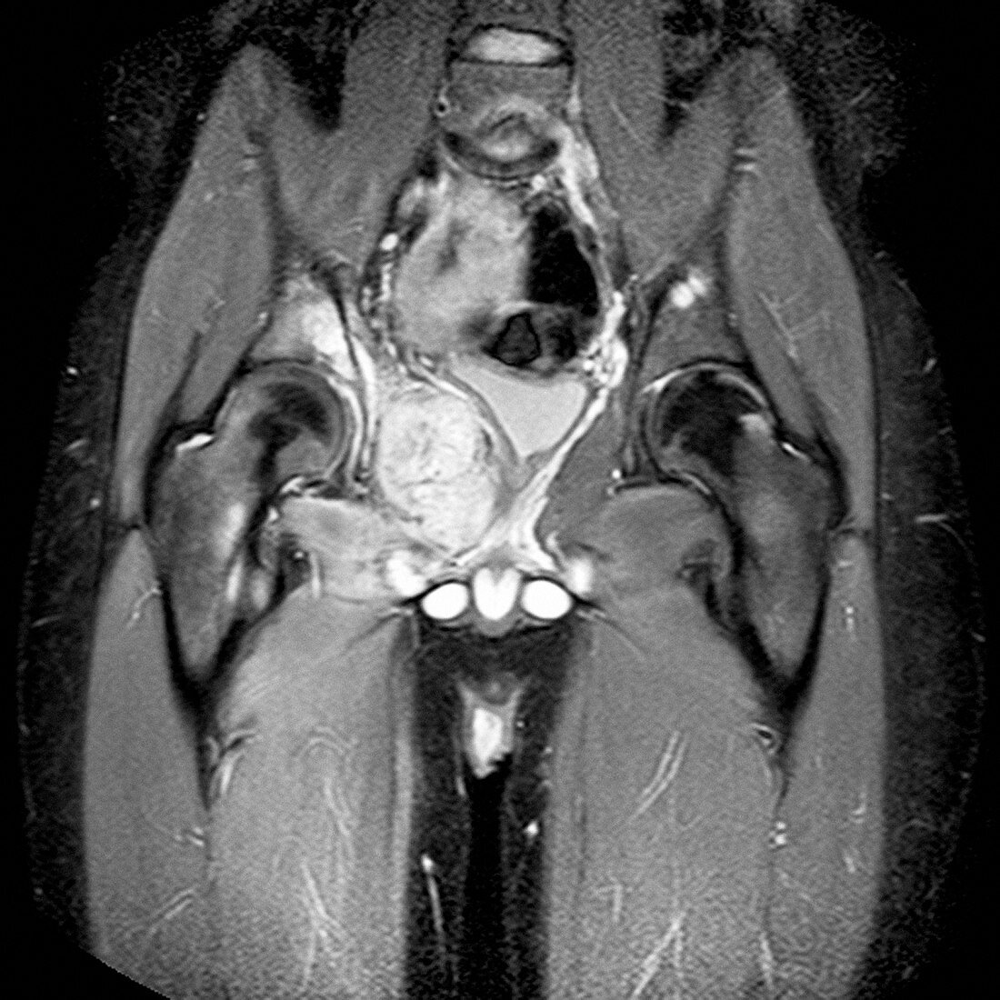 Ewing's sarcoma,MRI scan