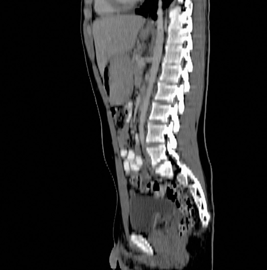Ewing's sarcoma,CT scan