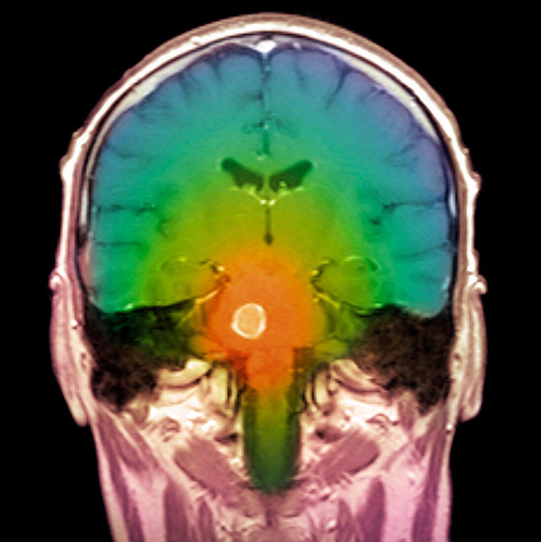 Brain tumour,MRI scan