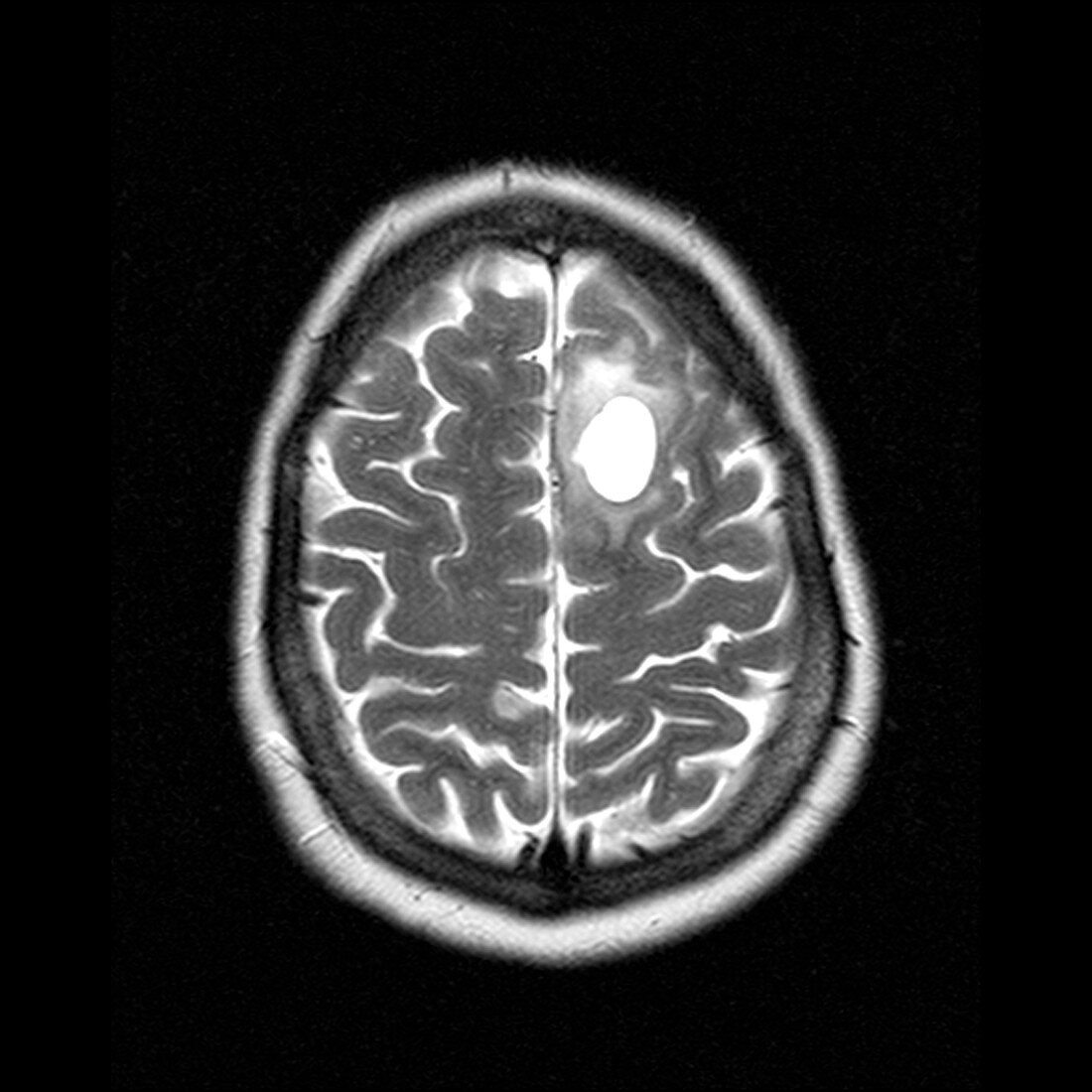 Brain tumour,MRI scan