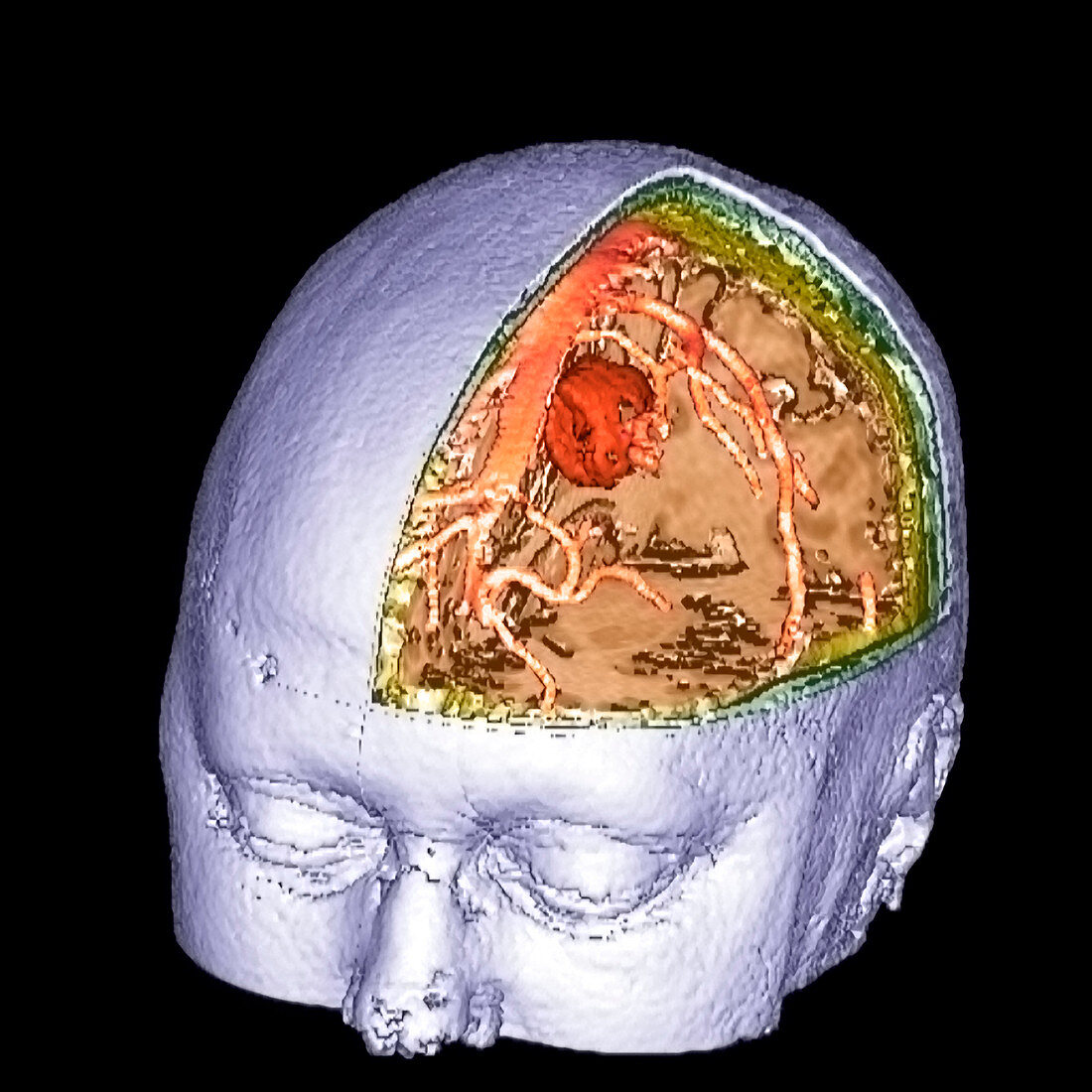 Brain tumour,3-D MRI scan