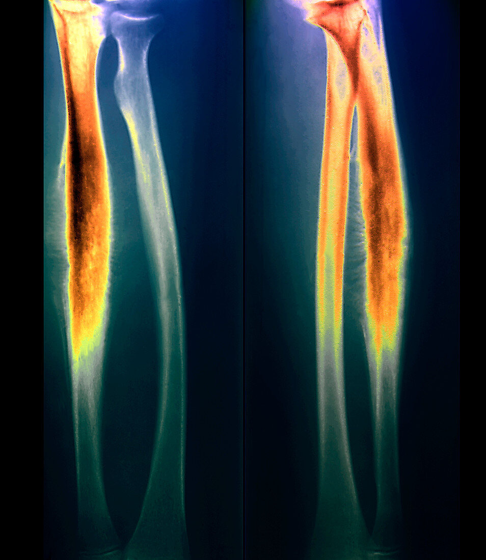 Ewing's sarcoma,X-ray