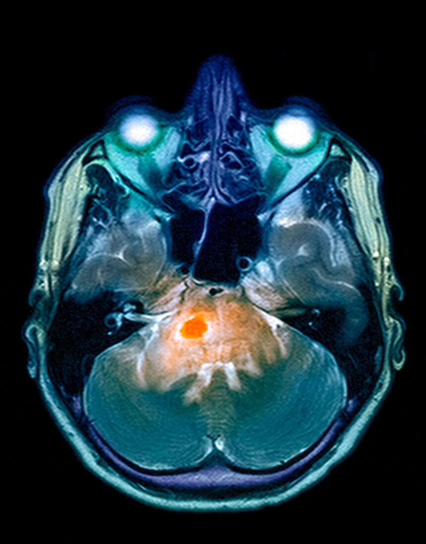 Brain tumour,MRI scan