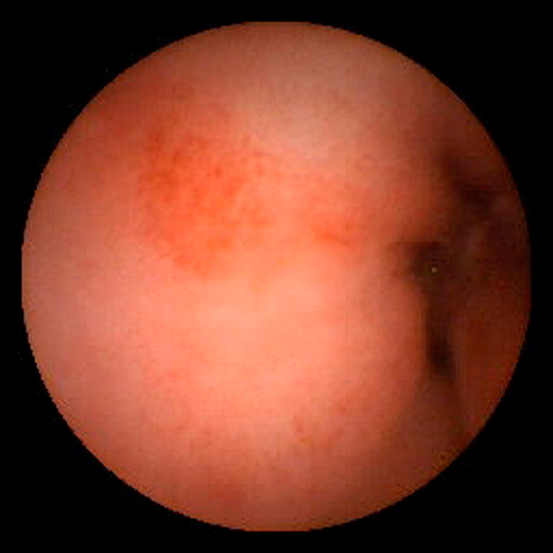 Inflammation of the duodenum,pill camera