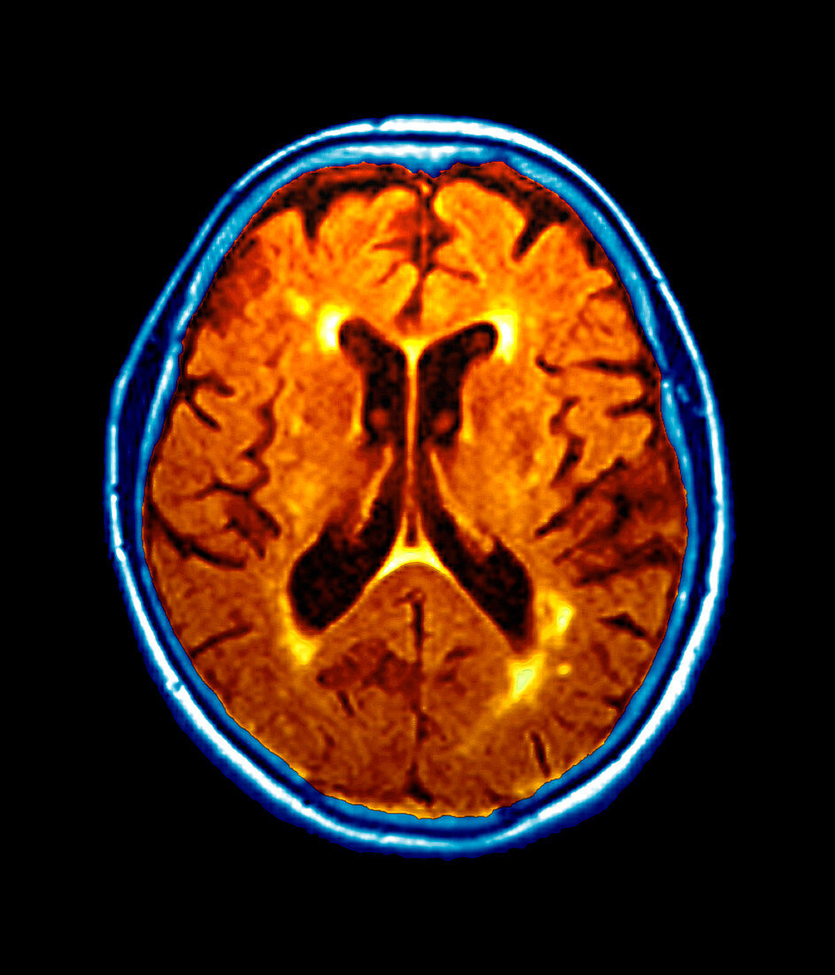 Dementia,MRI scan