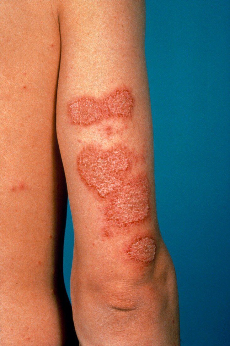 Discoid eczema affecting upper arm