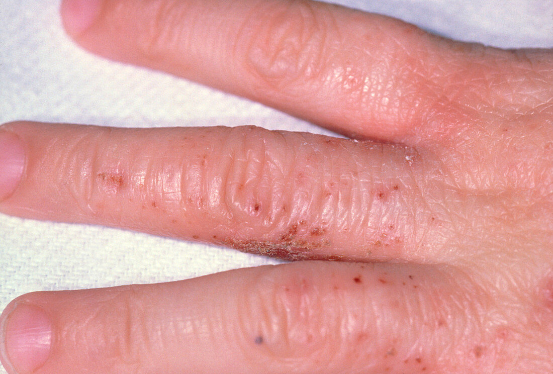 Eczema rash on a child's hand