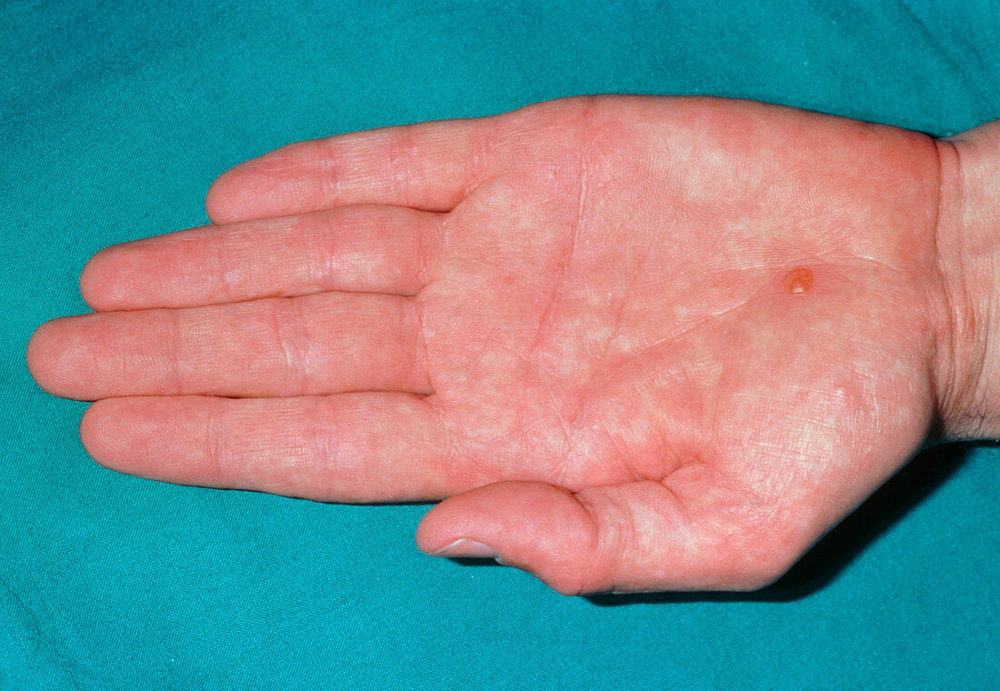 Mild form of pompholyx (eczema) over the palm