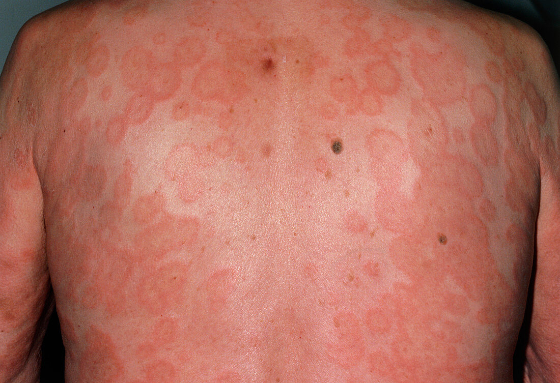 Erythema multiforme skin rash on back of male