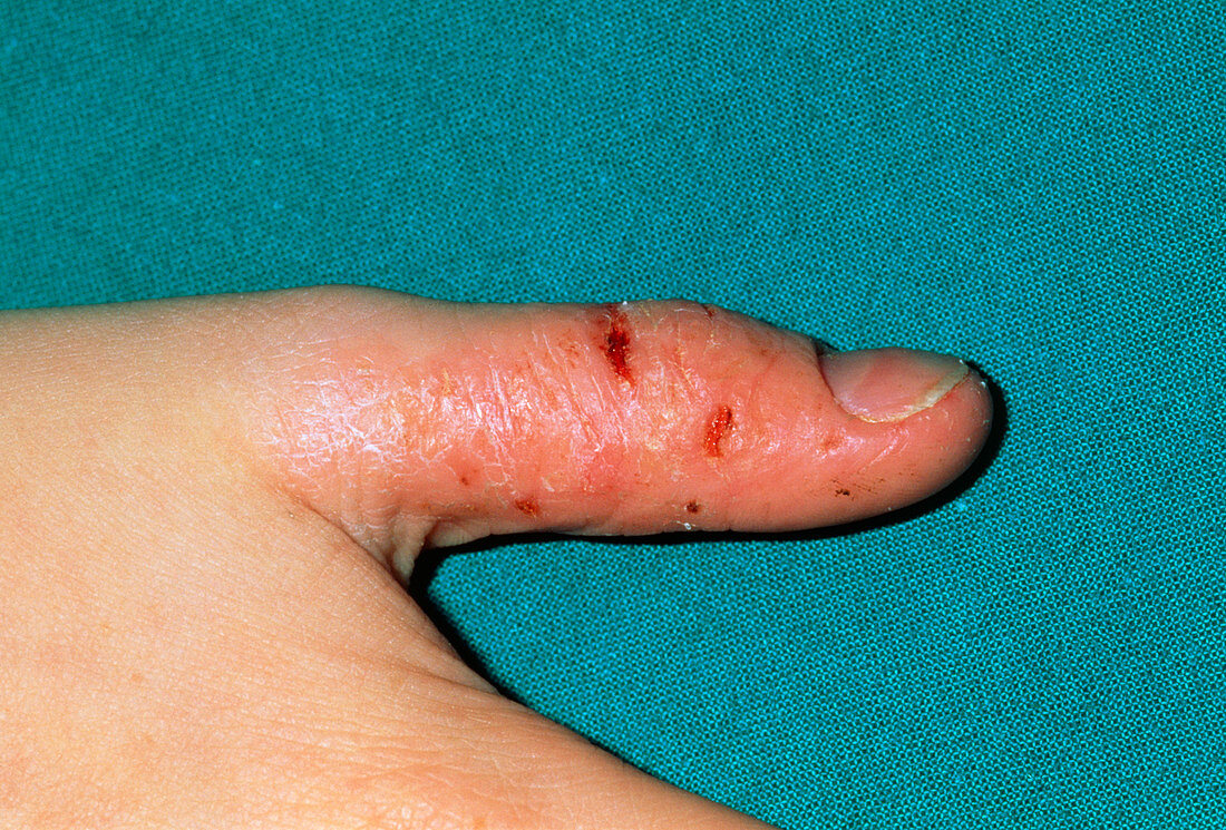 Eczema on child's thumb due to thumb-sucking