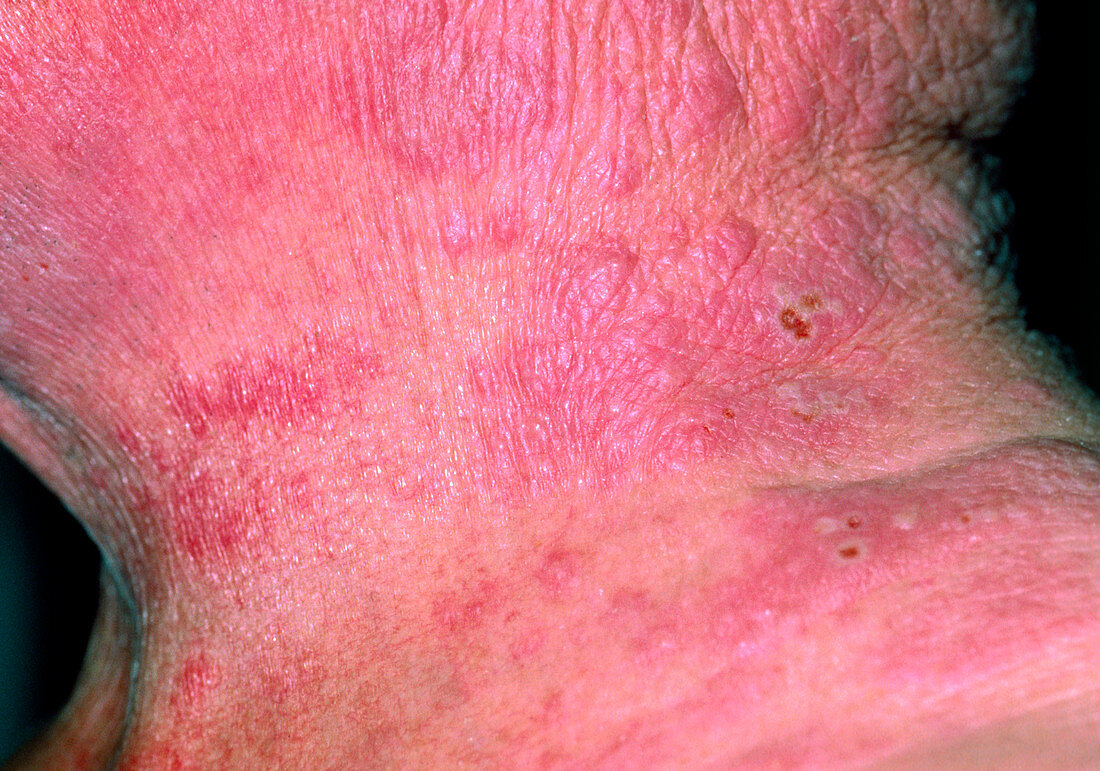 Neck of patient with eczema rash,and shingles
