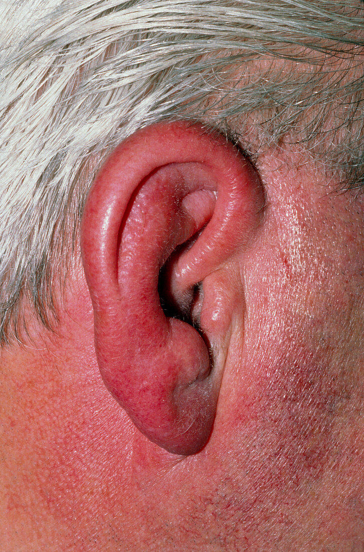 Erysipelas of earlobe due to otitis externa
