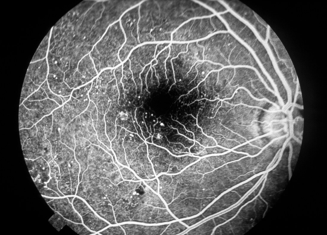 Fluorescein angiogram in diabetic retinopathy