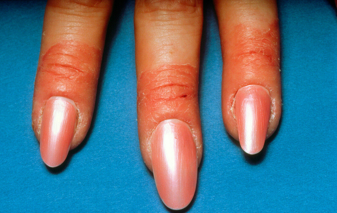 Contact dermatitis of the fingers