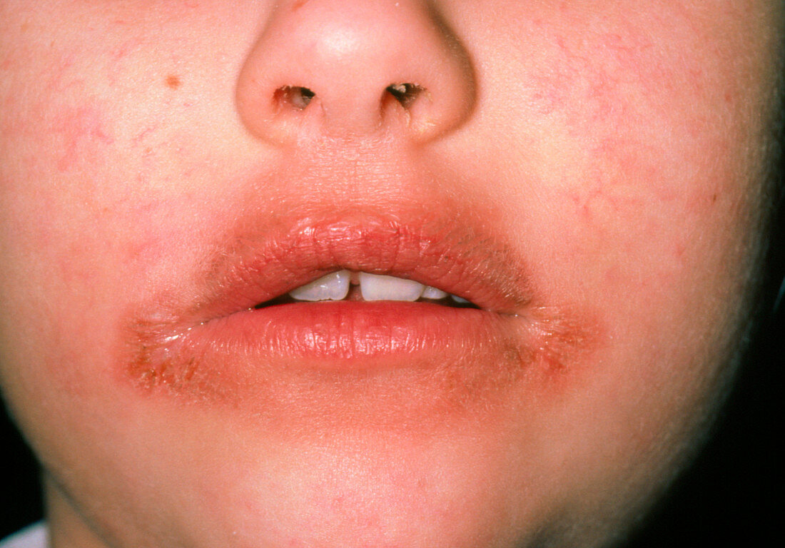 Dermatitis around the mouth of a child