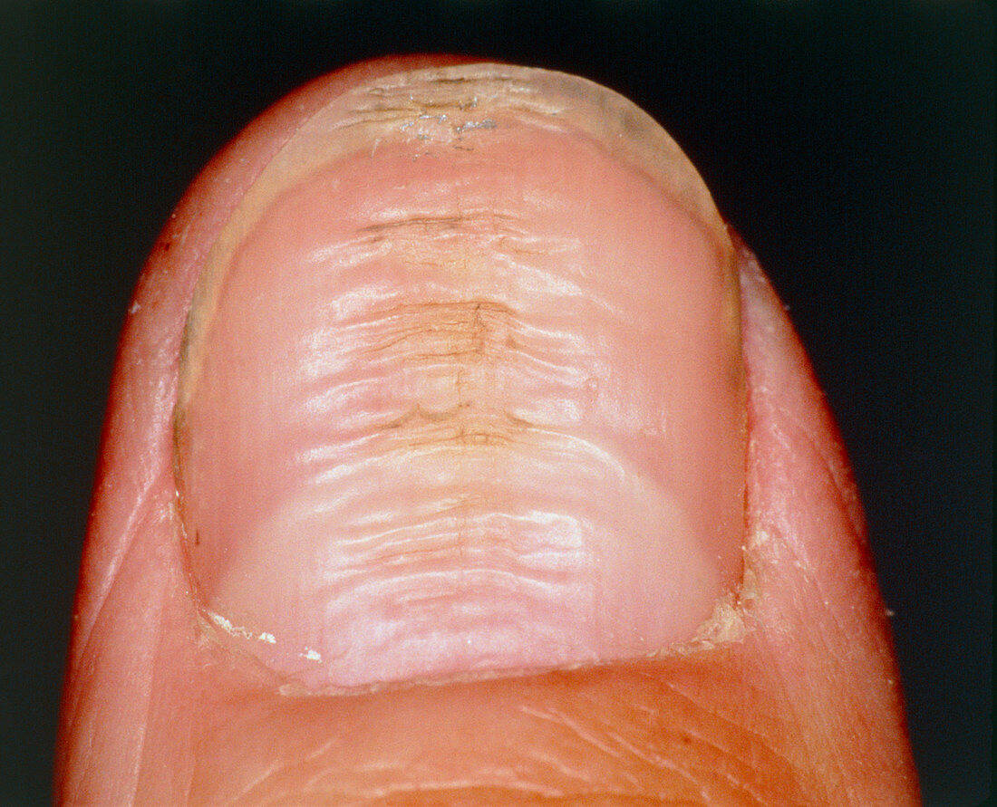 Horizontal ridges on fingernail or nail dystrophy