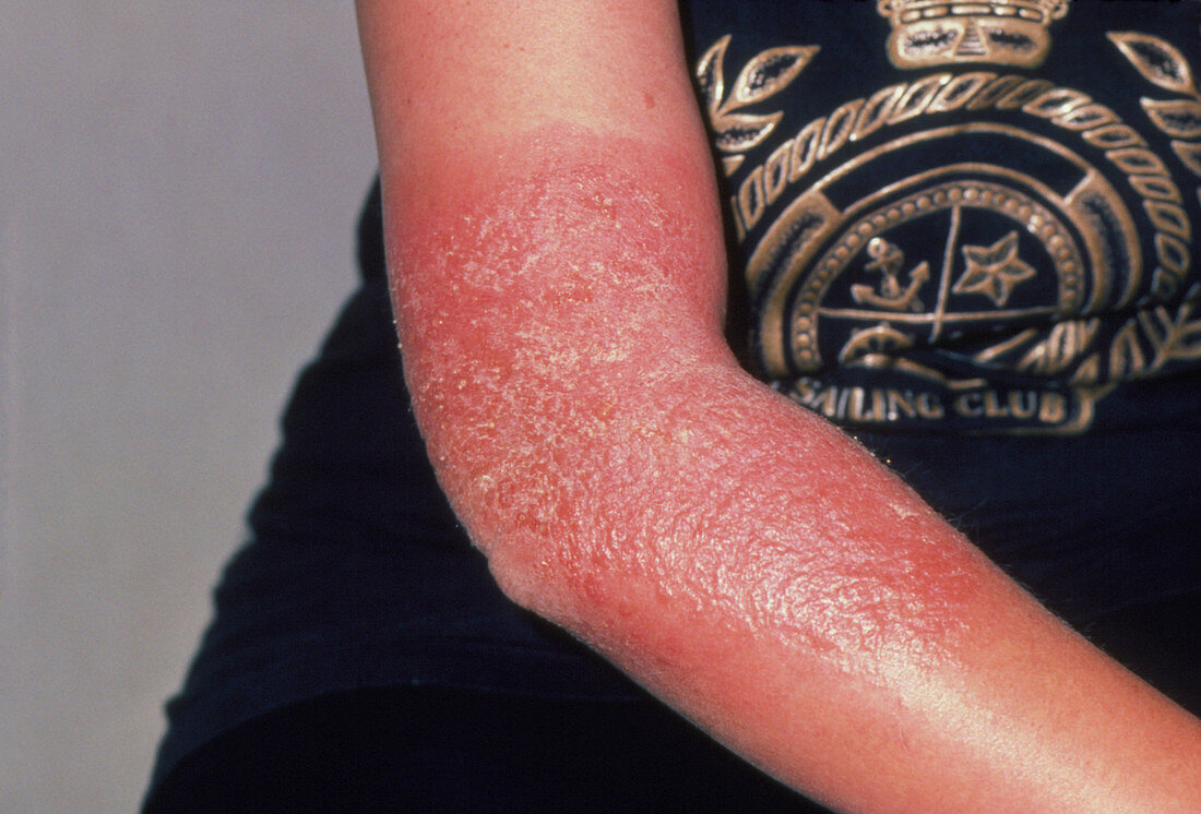 Dermatitis: photosensitivity to Ketoprofen Gel