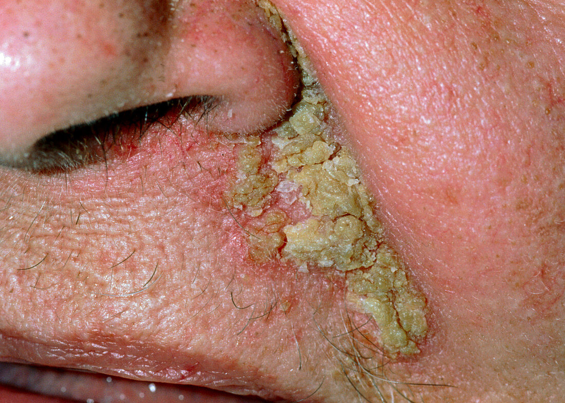 Close-up of seborrhoeic dermatitis on face