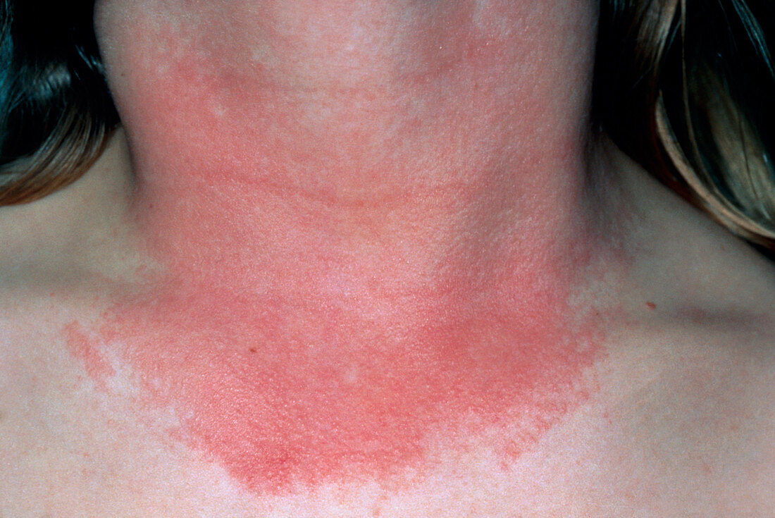 Photosensitive rash on woman's neck