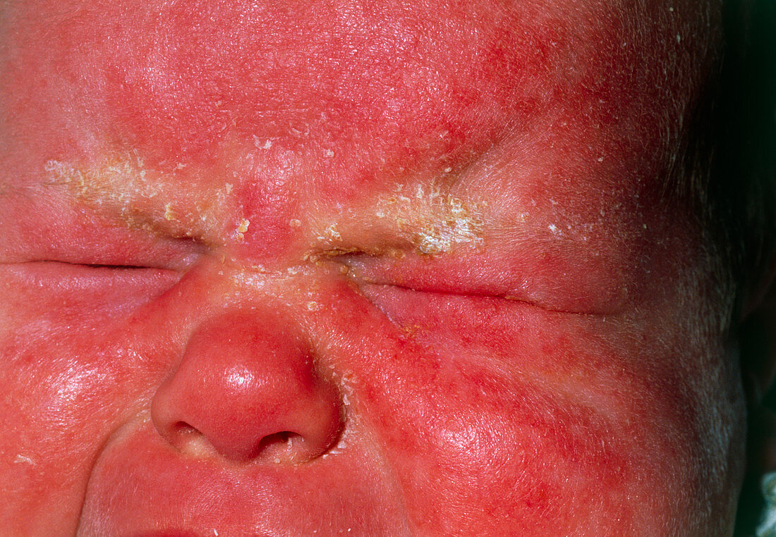 Close-up of seborrhoeic dermatitis on baby's face