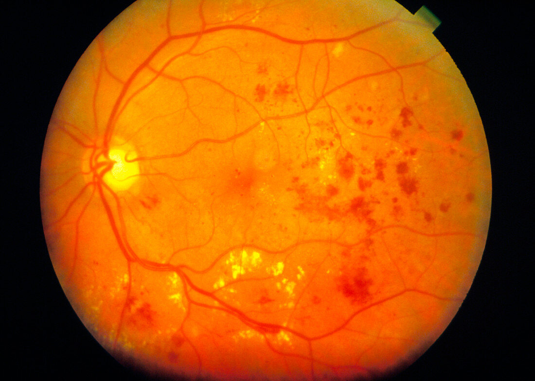 Ophthalmoscopy of eye with diabetic maculopathy