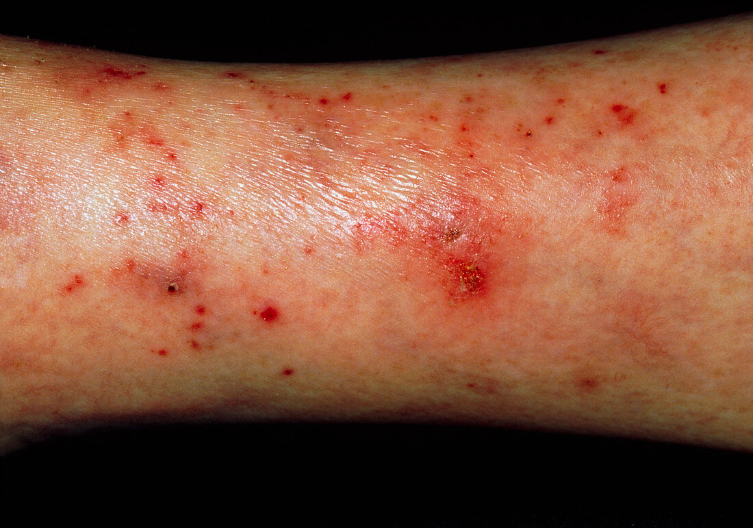 Dermatitis artefacta in an alcoholic patient