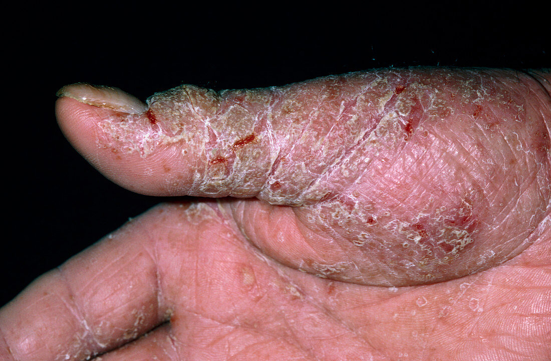 Man's thumb with contact dermatitis from rubber