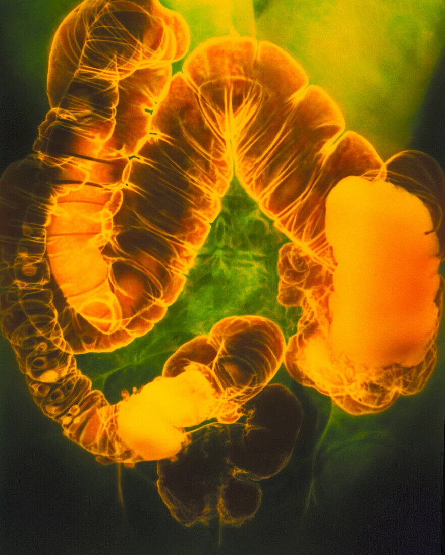 Coloured X-ray showing diverticulitis of the colon