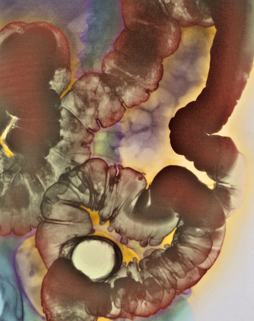 Diverticular disease,X-ray