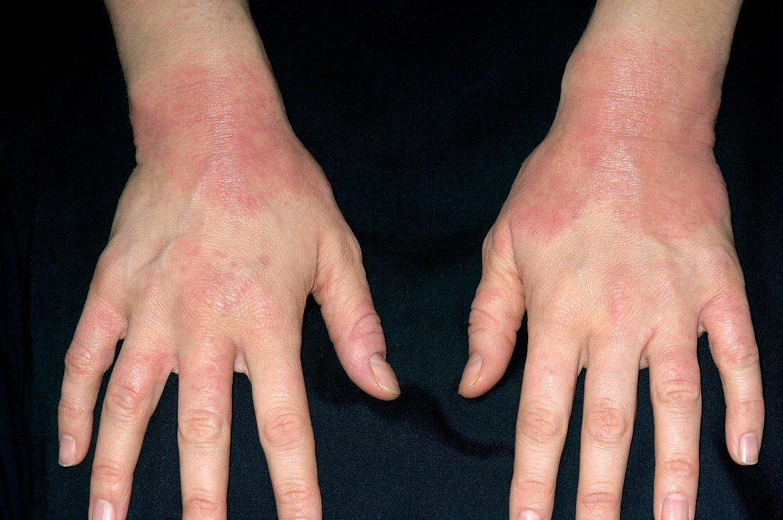 Eczema affecting the wrists