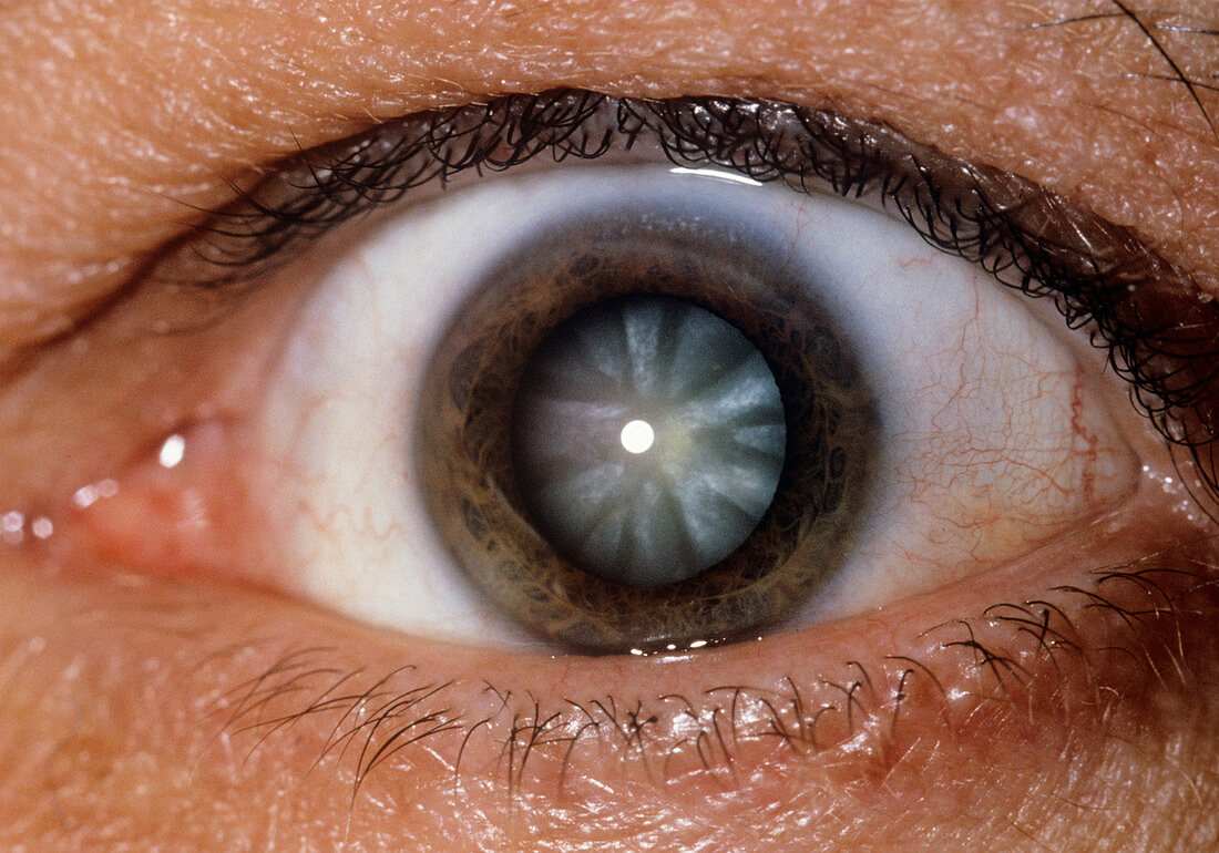 Close-up of eye showing cataract
