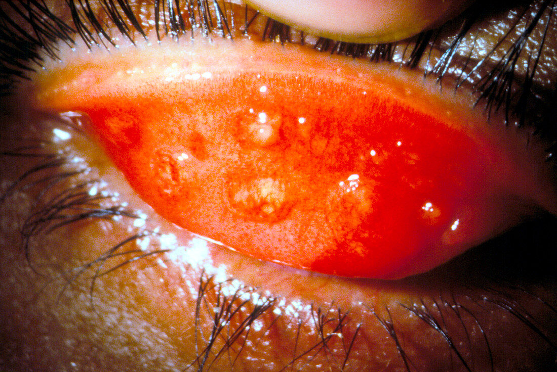 Inflamed eyelid in trachoma